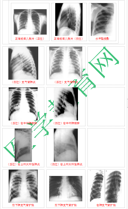 快收藏！臨床助理醫(yī)師實踐技能62個胸片（圖片診斷）