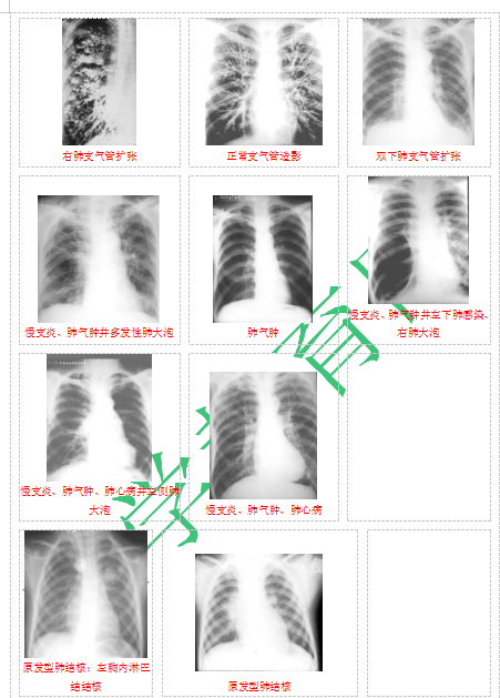 快收藏！臨床助理醫(yī)師實踐技能62個胸片（圖片診斷）