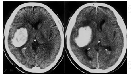 男55歲，左側(cè)肢體偏癱4小時(shí)，有高血壓史，診斷為